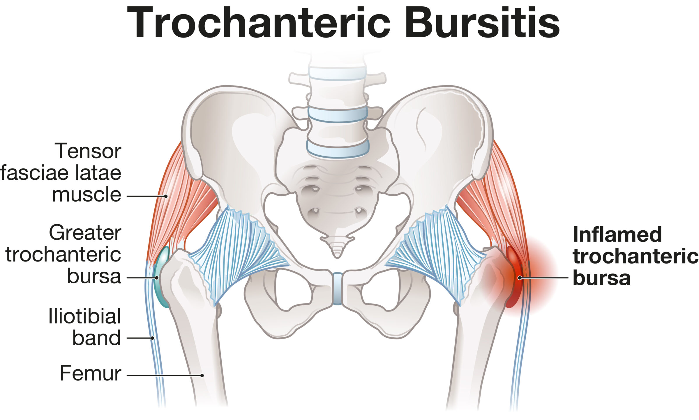 Trochanteric Bursitis. Hip Pain. Inflammation. Bursa. Labeled Illustration