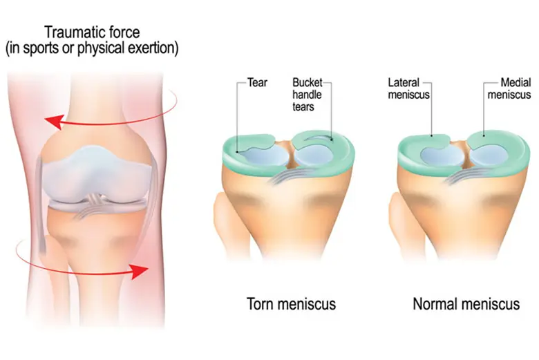 knee2