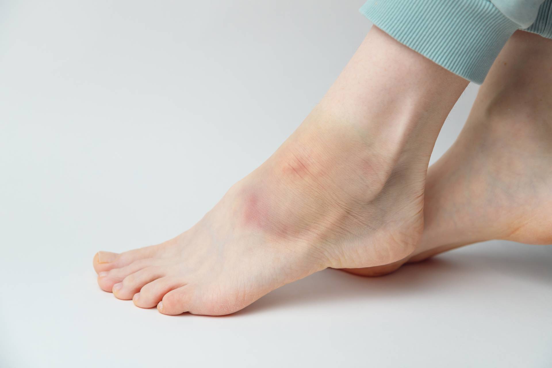 sprained-ankle-with-bruise-and-swelling-on-a-femal