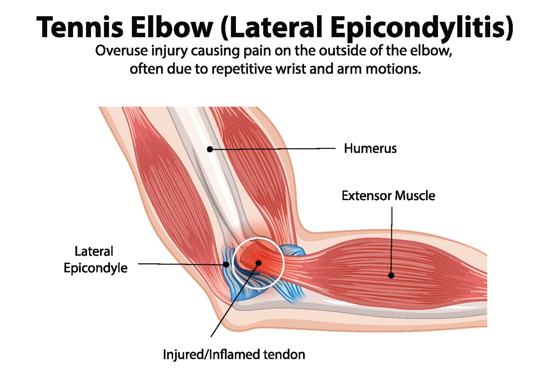 tenniselbow